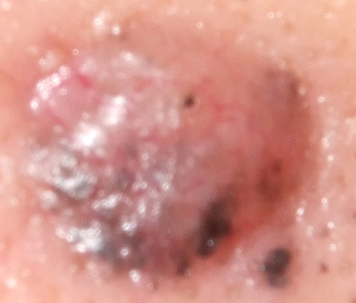 皮膚腫瘍2
