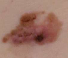 皮膚腫瘍4