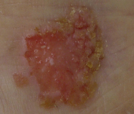 皮膚腫瘍5