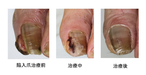 陥入爪治療前・治療中・治療後